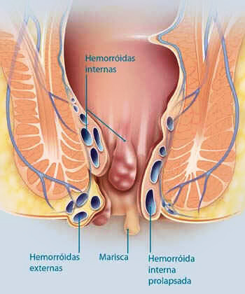 Cirurgia de Hemorroida